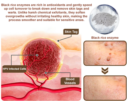 Virexo™ Black Rice Skin Repair Essence Cream (Removes warts and skin growths, improves keratin buildup and seborrheic dermatitis, follicular keratosis, age spots, and bruising)