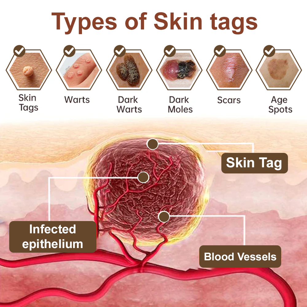 Virexo™ Black Rice Skin Repair Essence Cream (Removes warts and skin growths, improves keratin buildup and seborrheic dermatitis, follicular keratosis, age spots, and bruising)