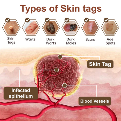 Virexo™ Black Rice Skin Repair Essence Cream (Removes warts and skin growths, improves keratin buildup and seborrheic dermatitis, follicular keratosis, age spots, and bruising)