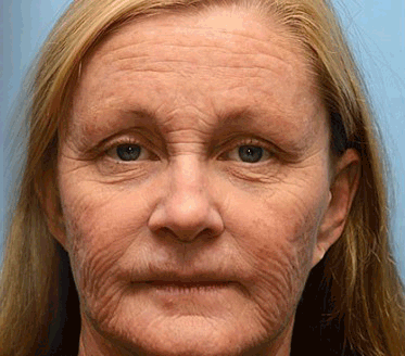 👨‍⚕️Made and shipped from Australia💫 Botox & Vita-A Retinol Shot Wrinkle-Lift Tightening cream - Last Day Promotion 70% OFF